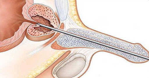 Nội soi bốc hơi bóc phì đại tiền liệt tuyến lành tính