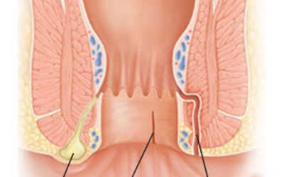 Xuất Hiện Lỗ Rò Hậu Môn Phải Làm Gì? – Tham Vấn Y Khoa