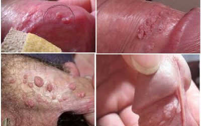 Bị Sưng Phồng Quy Đầu Sau Khi Quan Hệ? Bác Sĩ Chuyên Khoa Tư Vấn