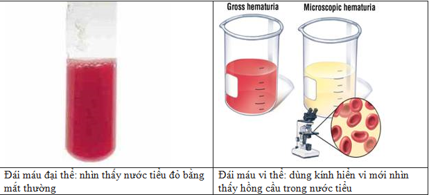 Tiểu máu đại thể