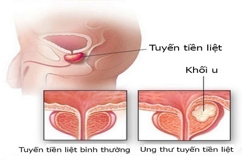 ung thư tiền liệt tuyến