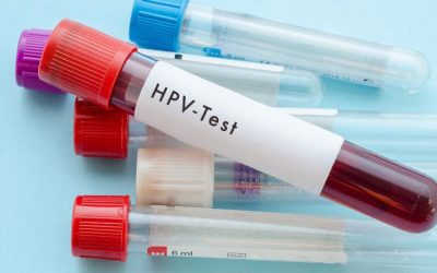 Xét Nghiệm HPV Là Gì? Xét Nghiệm Hpv Bao Lâu Thì Có Kết Quả?