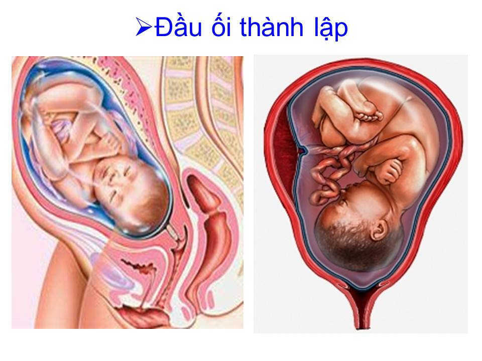 Cổ tử cung đã mở rộng, đầu thai nhi đã xuống thấp nhưng có dấu hiệu suy thai...