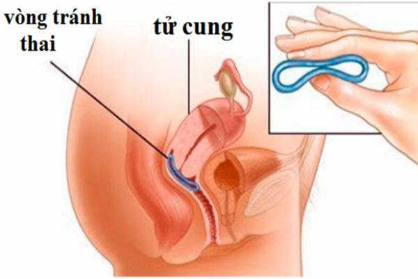 Dụng cụ tránh thai bị dịch chuyển