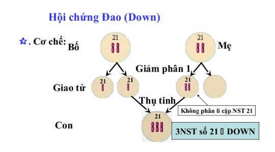 Hội chứng Down