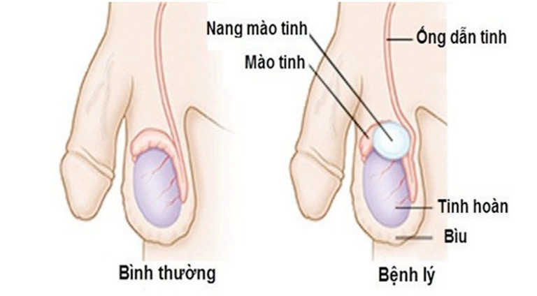 Nang mào tinh