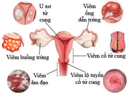 Nữ giới mắc bệnh phụ khoa