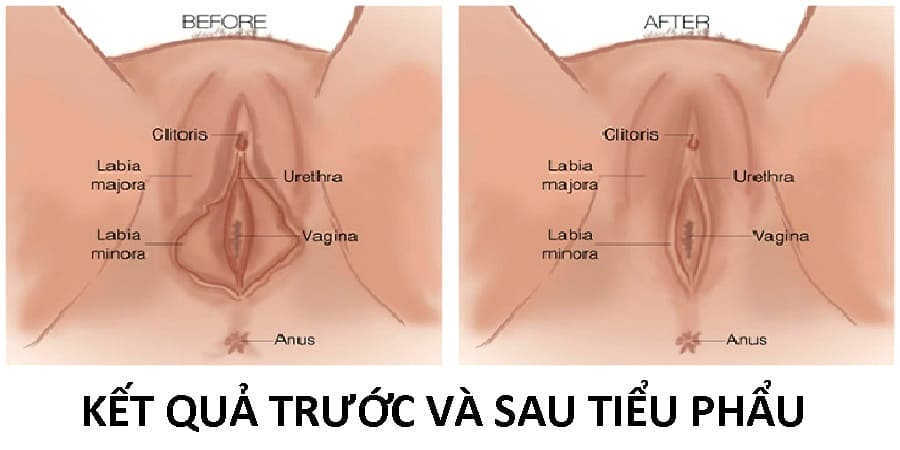 Quy trình vá màng trinh là yếu tố quyết định việc vá màng trinh có ảnh hưởng gì không?