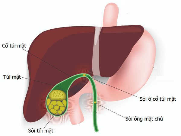 Sự tắc nghẽn ống dẫn mật