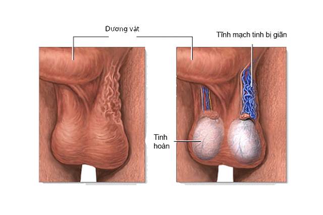 Tinh hoàn bị chảy xệ, căng tức vùng bìu…