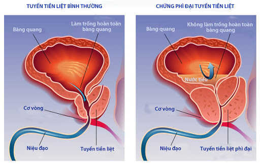 Tuyến tiền liệt bị phì đại chèn ép lên ông niệu đạo