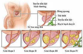 Ung thư tiền liệt tuyến được chi thành 4 giai đoạn