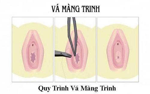 Vá màng trinh có ảnh hưởng gì không