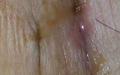 Vết Khâu Tầng Sinh Môn Bị Sưng Có Sao Không?