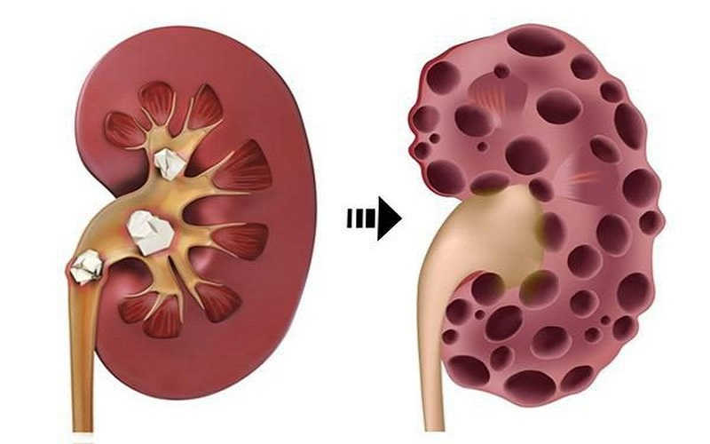 Bệnh lý về thận