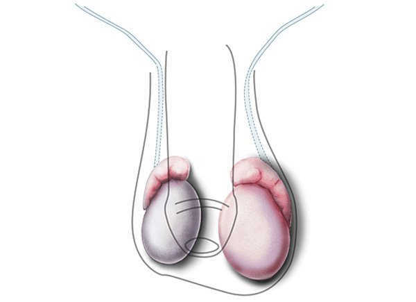 Bệnh teo tinh hoàn là gì?