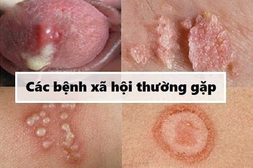 Các bệnh xã hội thường gặp