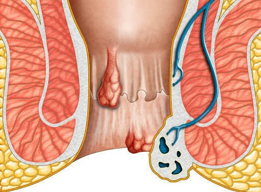 Có cục cứng ở hậu môn là bệnh gì?