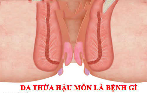 Da thừa tại hậu môn