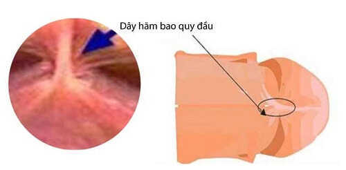 Đứt dây hãm bao quy đầu có sao không?