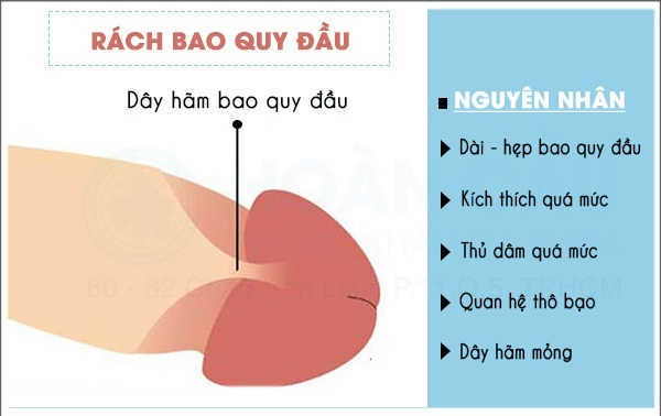 Lợi ích của việc cắt dây hãm bao quy đầu 