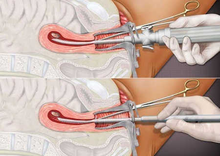 Những Dấu Hiệu Hút Thai Thành Công Là Gì?