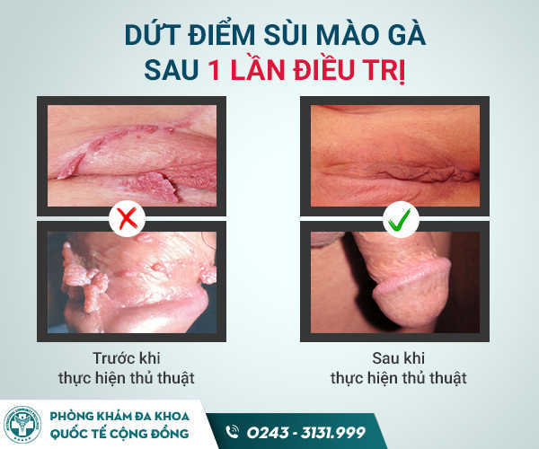 Phương pháp IRA sùi mào gà