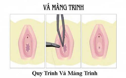 Phương pháp xâm lấn tối thiểu vá màng trinh