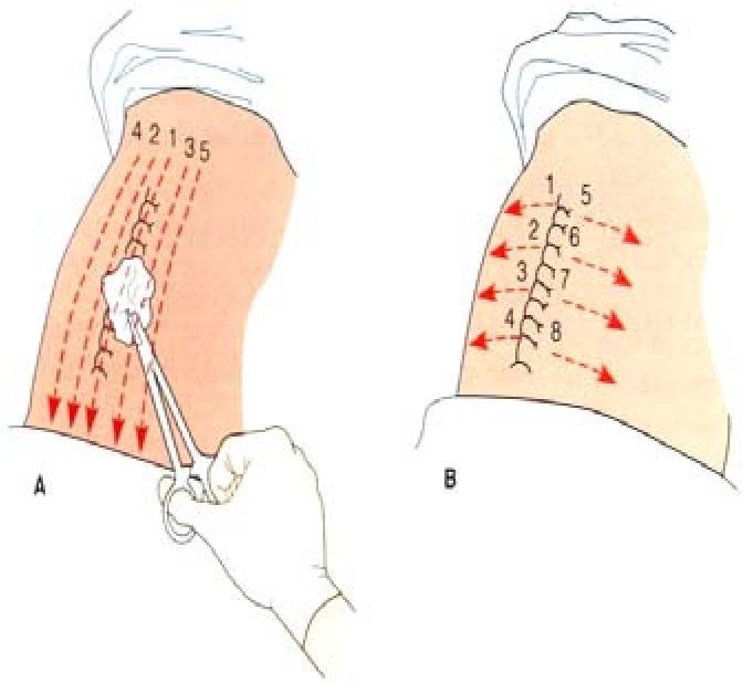 Rạch cắt mảng xơ và vá che phủ