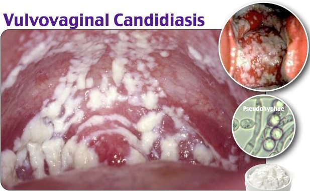 Rửa vùng kín bằng phèn chua tiêu diệt nấm Candida