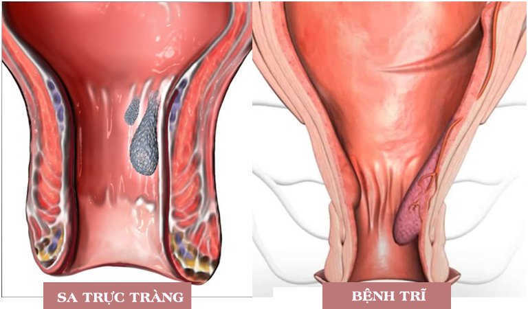 Sa trực tràng