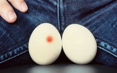 Tinh Hoàn Bị Nổi Hột Là Dấu Hiệu Của Bệnh Gì?