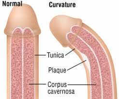 Triệu chứng biểu hiện của bệnh dương vật cong là như thế nào?