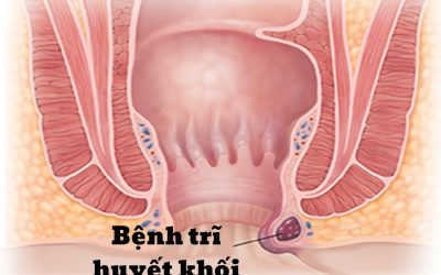 [ Cảnh Báo ] – Bệnh Trĩ Xuất Huyết Coi Chừng Biến Chứng Nguy Hiểm