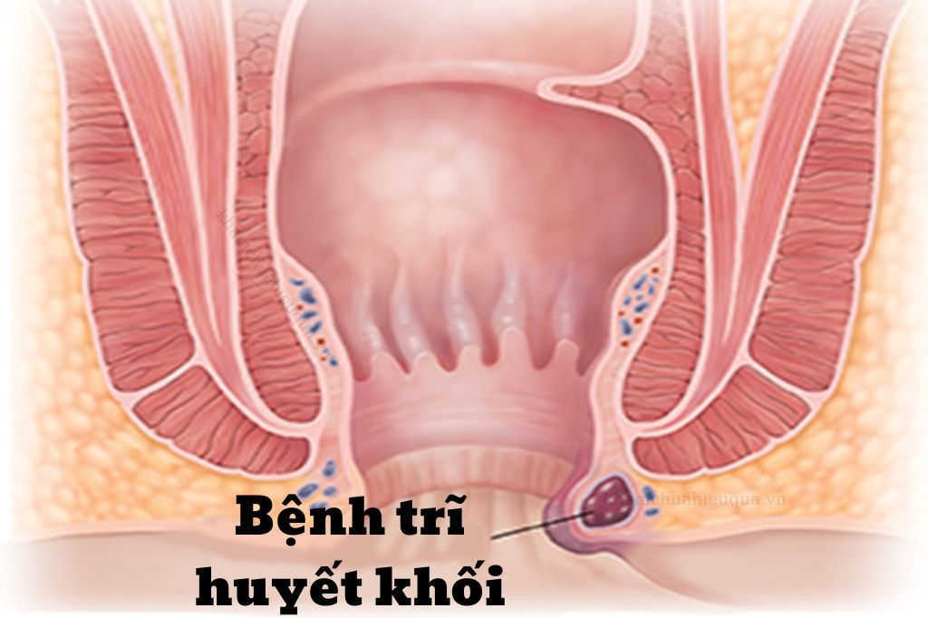 Bệnh trĩ xuất huyết là như thế nào?