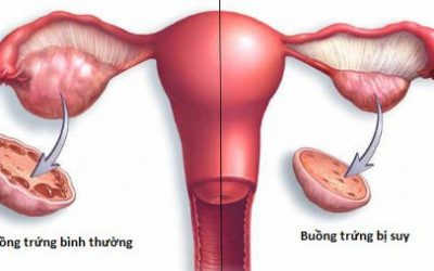 Suy Buồng Trứng Có Chữa Được Không?