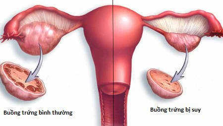 Thế nào là suy buồng trứng sớm?