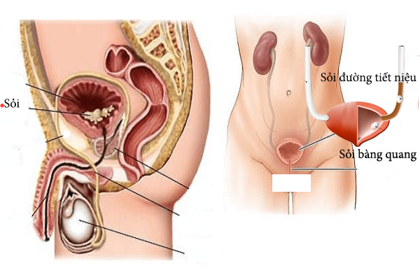 Cách điều trị bệnh viêm bàng quang như thế nào?