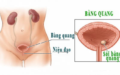 Viêm bàng quang ở nữ giới: Nguyên nhân, triệu chứng và cách điều trị