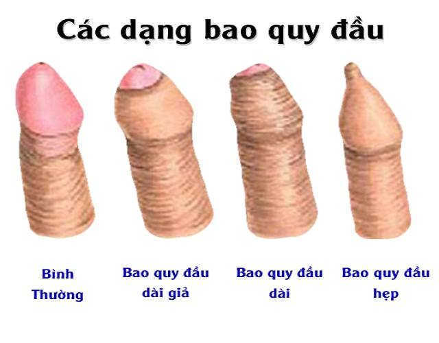 Dấu hiệu bán hẹp bao quy đầu bạn nên biết