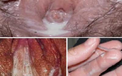 Bệnh lậu lây qua con đường nào? Bệnh lậu có lây qua đường ăn uống không?