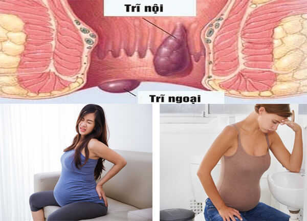 Dấu hiệu bị trĩ khi mang thai cần sớm được nhận biết