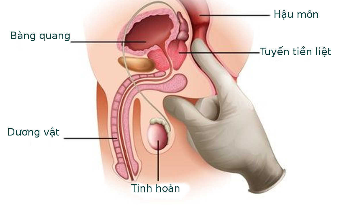 “Cặc” đau nhức do viêm tuyến tiền liệt