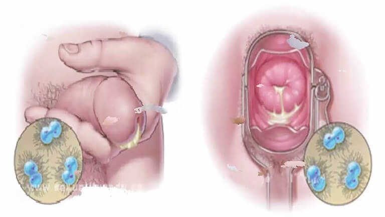 Khái quát cơ bản về bệnh lậu