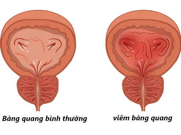 Một số thông tin về bệnh viêm bàng quang 