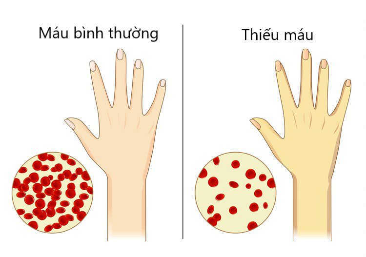 Ngăn ngừa tình trạng thiếu máu