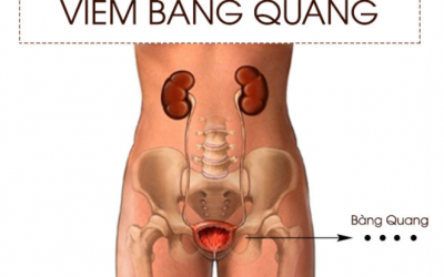 Viêm Bàng Quang Có Lây Không? Chữa Thế Nào Và Ở Đâu?