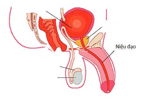 Viêm hoặc hẹp lỗ ngoài niệu đạo