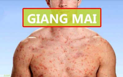 Giải đáp : Thời gian ủ bệnh của giang mai trong bao lâu?