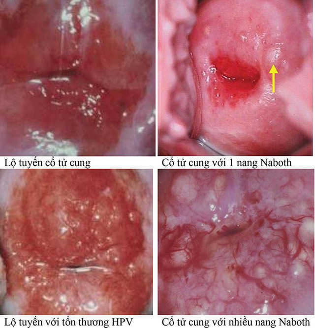 Biến chứng của viêm lộ tuyến nang naboth nên chú ý